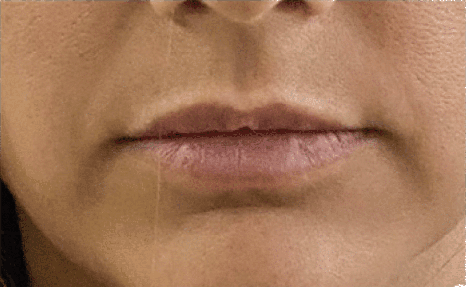 לפני עיבוי שפתיים