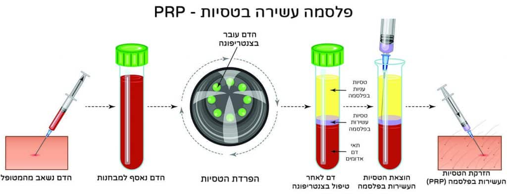 תהליך הפקת והזרקת PRP