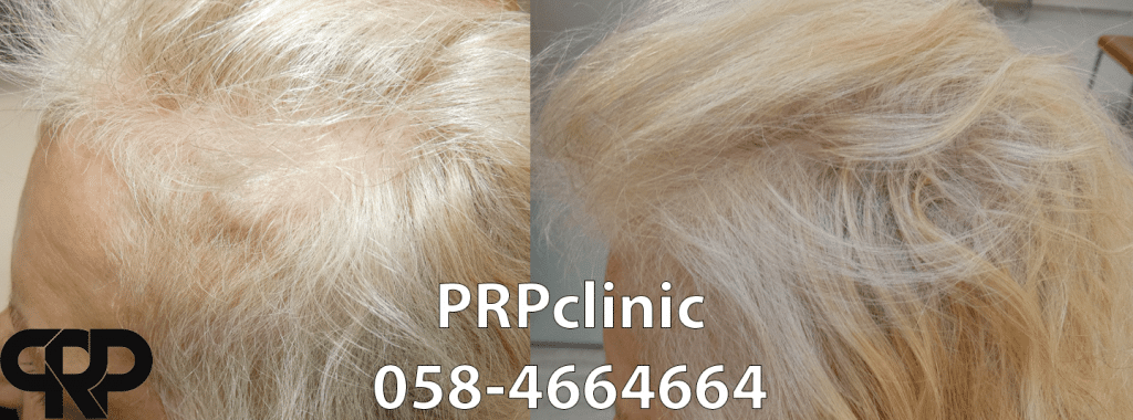 דוגמא לתוצאות טיפול PRP בנשירת שיער נשית