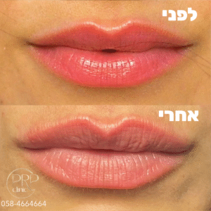 Lip Augmentation with Hyaluronic Acid