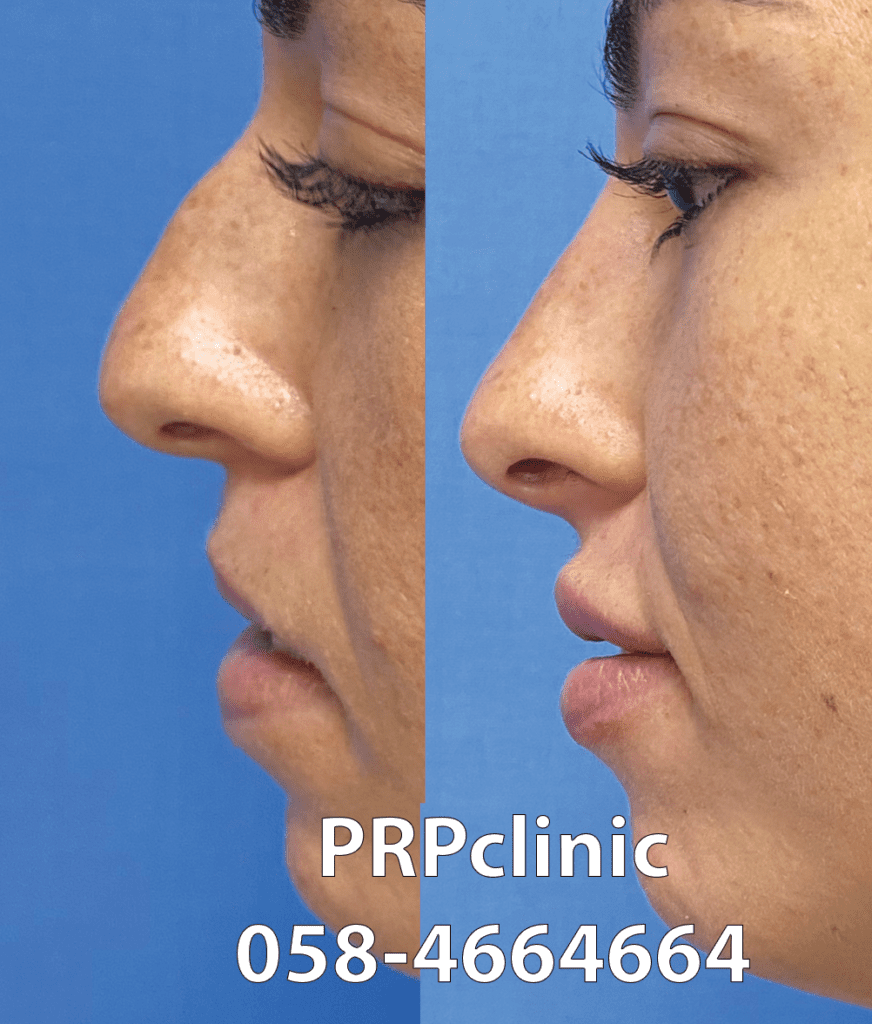 פיסול אף ועיבוי שפתיים במרפאת PRPclinic