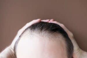 PRGF לטיפול במצבים שונים של נשירת שיער