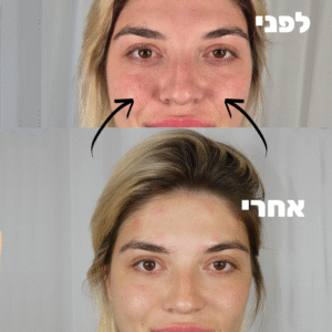 Nasolabial Folds filling young lady