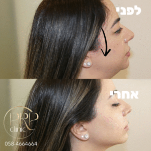 Jawline Contouring and Cheek filler for a woman