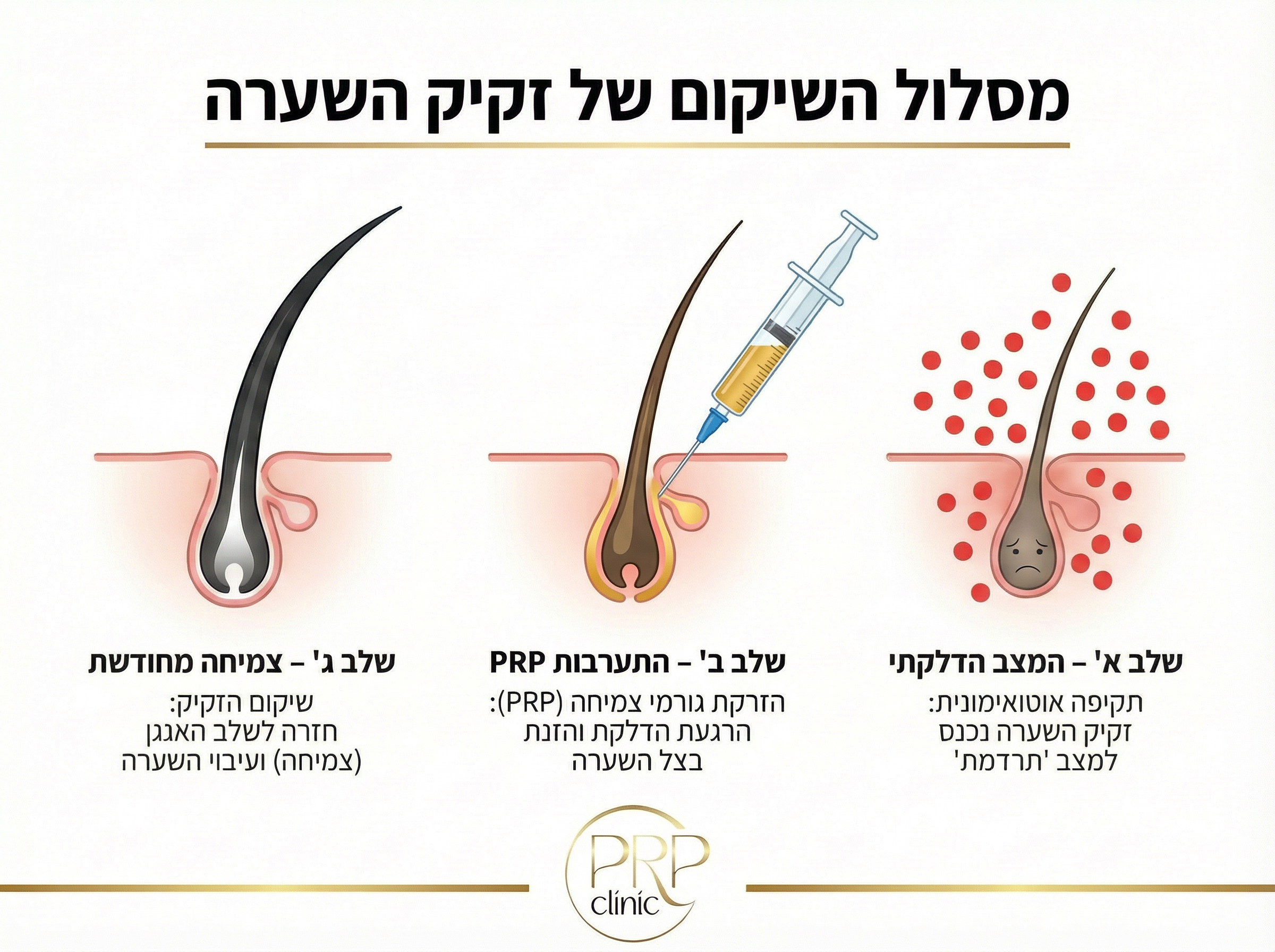 טיפול באלופציה אראטה באמצעות PRP - תרשים הסבר רפואי
