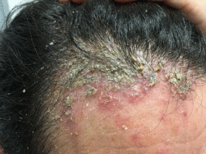 סבוריאה חריפה (Seborrheic Dermatitis): המדריך הרפואי המלא לטיפול ושיקום הקרקפת