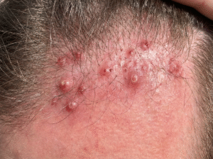 פוליקוליטיס בקרקפת