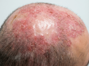 אלופסיה מצולקת