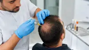 האם PRP יכול להצמיח שיער באזורים קירחים